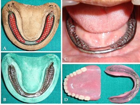 metal denture base fabrication|full metal plate denture.